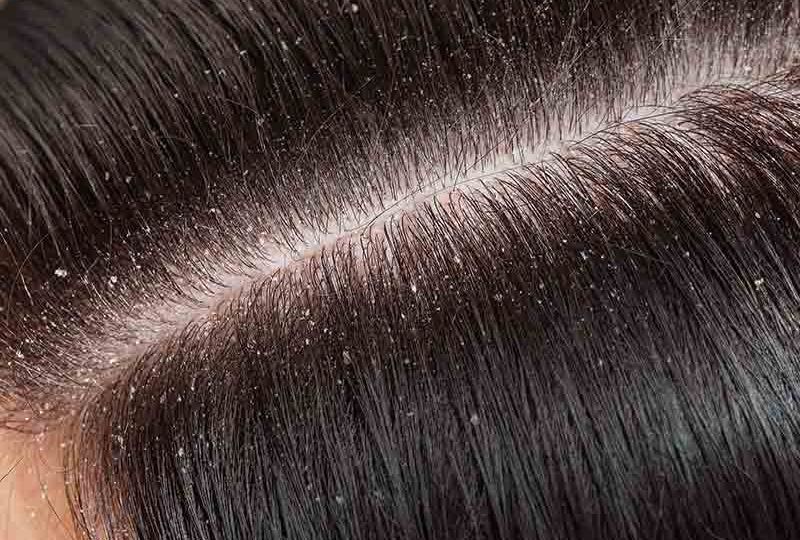 what causes dandruff and treatment