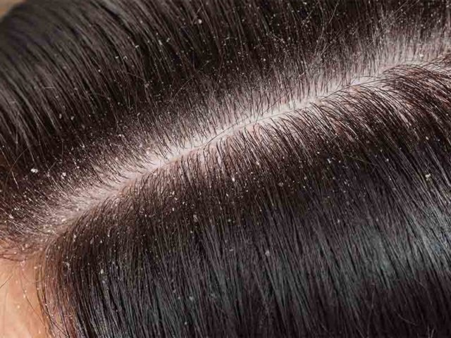 what causes dandruff and treatment